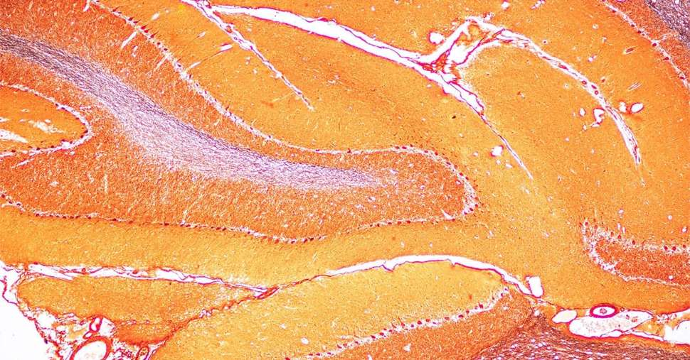 Cracking the code to unlock brain diseases